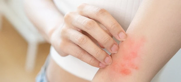 Skin reactions