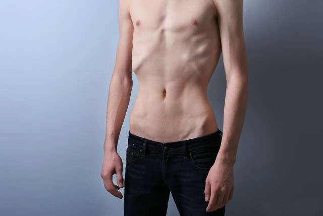 Abnormal increase in appetite Abnormal increase in appetite
